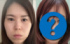 症例ちゃんさんの整形前と整形後のビフォーアフター（TikTok／@shorei_chanより）